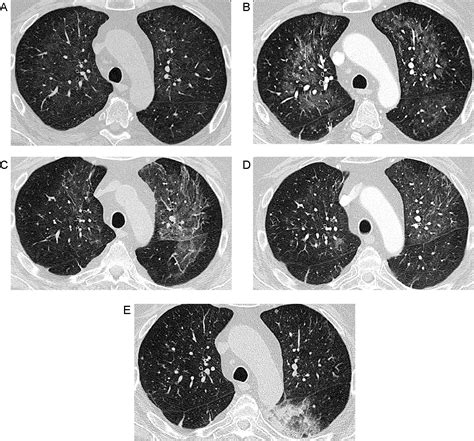 Hrct Features Of Pneumocystis Jiroveci Pneumonia And Their Evolution