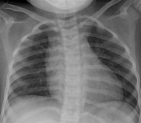 Chest X Ray Showing Cardiomegaly The Cardiothoracic Ratio Was 06 At