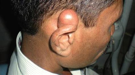 Blind Spot Behind Ear Blinds