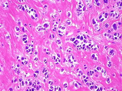 Pathology Outlines Perivascular Epithelioid Cell Tumor Pecoma