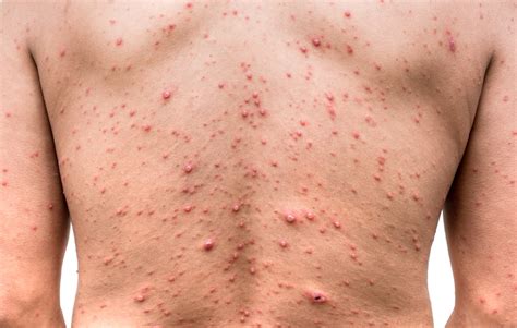 Hives Vs Rash Whats The Difference Between Them