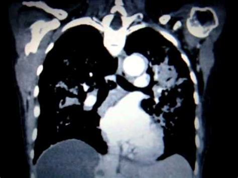 Probably $500 to $1,000 to do the initial diagnostic testing. CT scan - Lung cancer - YouTube