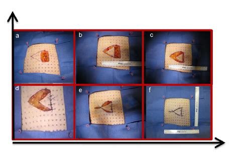 Successive Steps Of A V Y Advancement Flap A Design Of A Triangular Download Scientific