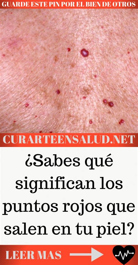 ¿sabes Qué Significan Los Puntos Rojos Que Salen En Tu Piel Remedies