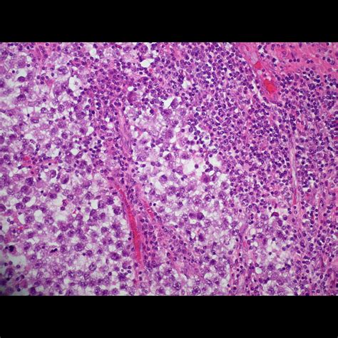 Esophagitis is an inflammation of the lining of the esophagus, the tube that carries food from the throat to the stomach. Images | Radiopaedia.org