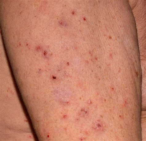 how do you get scabies causes symptoms treatment pictures