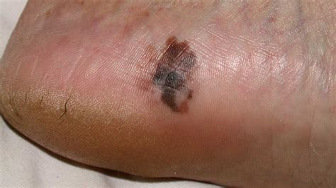 Foot Melanoma Symptoms Causes And Treatments