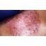 Skin Problems Image Gallery  HowStuffWorks
