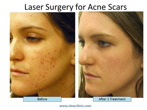 Best Treatments For Acne Scars Yahoo Answers