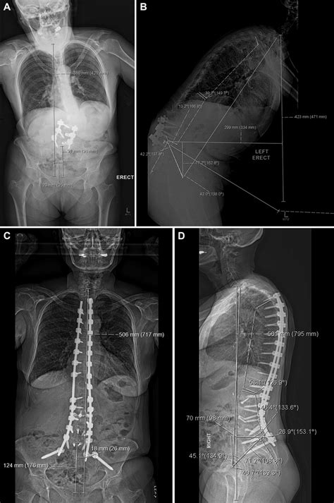 A Preoperative Standing Radiographs Ap View With Coronal Translation