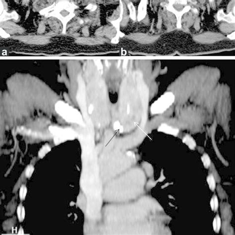 Multinodular Goiter Plain Axial A And Contrast Enhanced Axial B