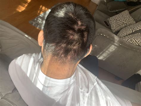 √100以上 Bumps Back Of Head After Haircut 837525 Bump On Back Of Head