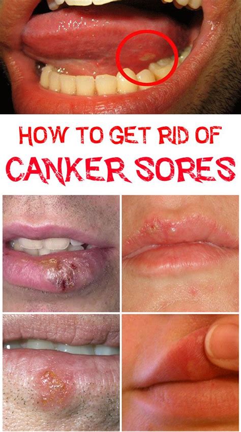 how to heal a canker sore on side of tongue