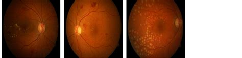 Automated Diabetic Retinopathy Detection Using Bag Of Words Approach