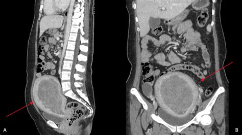 Cureus Brain Metastasis In A Young Patient With Uterine Carcinosarcoma