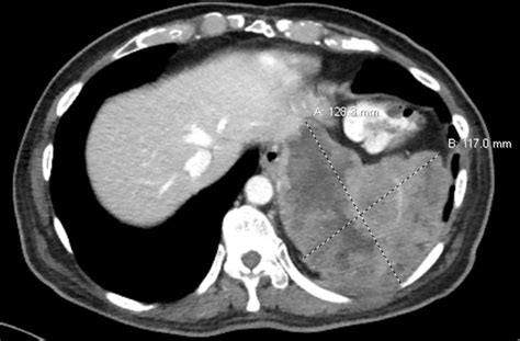 Abdominal Cyst Of Unclear Aetiology Gastrointestinal Stromal Tumour Or