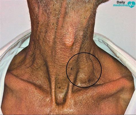 ‫عقدة فيرشو Virchows Lymph Node فوق Underneath Your Skin Arabic