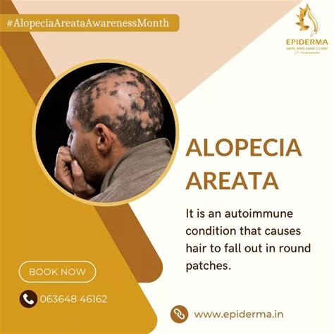 Ppt What Is Alopecia Areata Best Dermatology Centre In Jayanagar