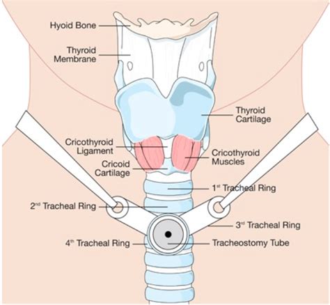 Core Em Common Tracheostomy Issues Laptrinhx News