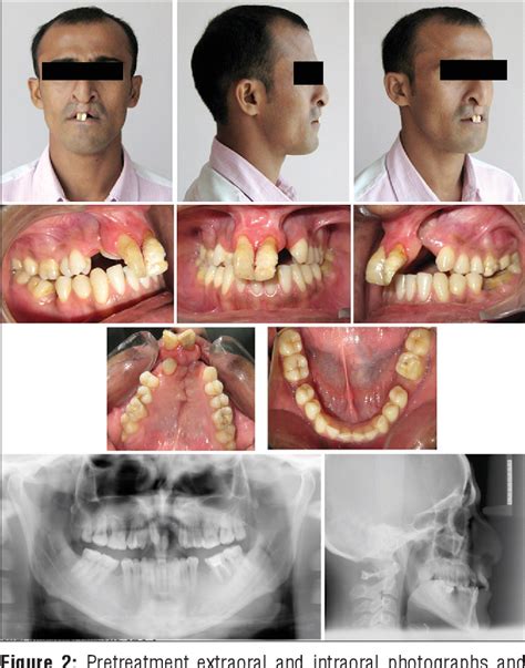 Figure 3 From Orthodontic Management Of Excessive Incisor Display Of An