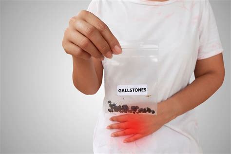 Diagnosis And Treatment Of Gallstones Sydney Gut Clinic