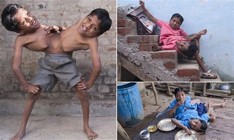 the indian conjoined twins who are worshipped as a divine incarnation and say they never want to