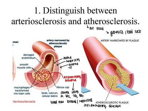 Cardiovascular Pathophysiology 1 Distinguish Between