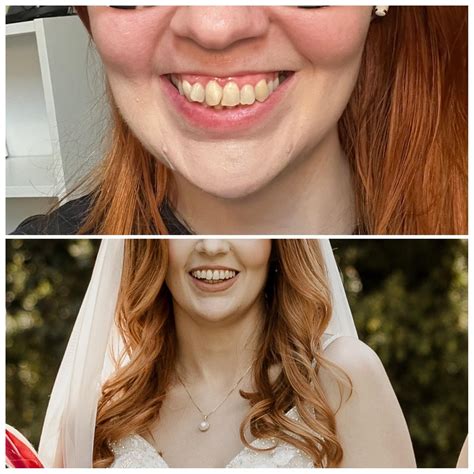 Life Changing Progress Already Before Invisalign And After Photo From