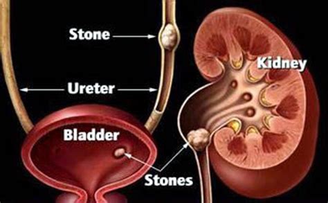 Urinary Stone Disease Daily Excelsior