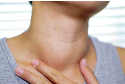 How To Shrink A Goiter Paloma Health