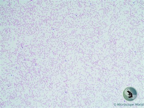 Microscope World Blog: Sickle Cell Anemia under the Microscope