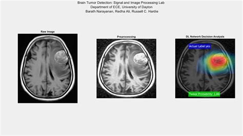 Brain Tumor Detection Using Deep Learning Youtube