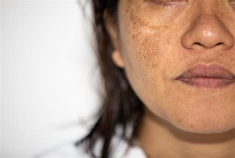 Common Dermatological Conditions In Skin Of Colour The Pharmaceutical