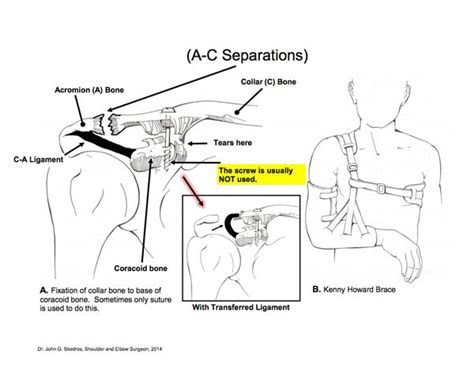 Shoulder Separation Procedures Dr Skedros Orthopaedics