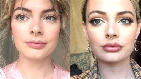 0 5ml lip fillers before and after one week vlog 💉 youtube