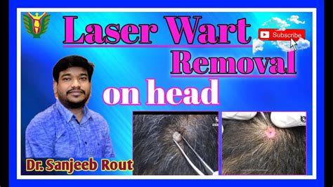 Laser Wart Removal Dr Sanjeeb Rout Balaji Skin And Hair Clinic