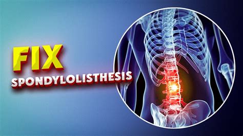 Fix Spondylolisthesis These 6 Easy Lumbar Listhesis Exercises That