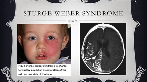 Pediatric Neurology Lecture Neurocutaneous Syndromes Youtube