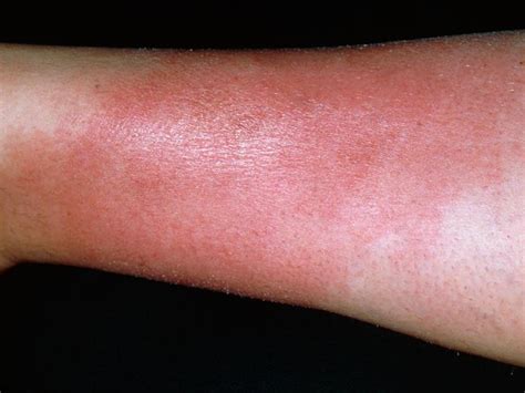 What Is Cellulitis Causes Symptoms And Treatments Yours