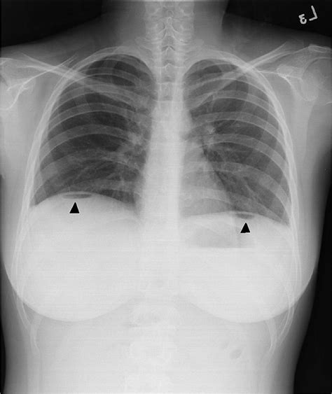 A Chest And Abdominal X Ray Showing Free Air Underneath The Diaphragm