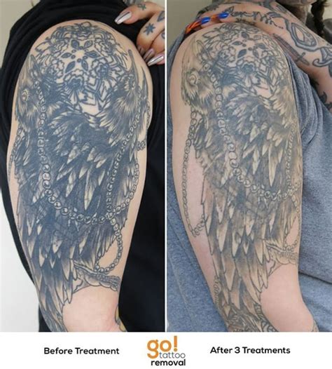 This sub is intended to discuss laser tattoo removal. 946 best Tattoo Removal In Progress images on Pinterest