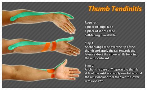 De Quervain S Tendinitis Occurs When The Tendons Around The Base Of The Thumb Are Irritated Or