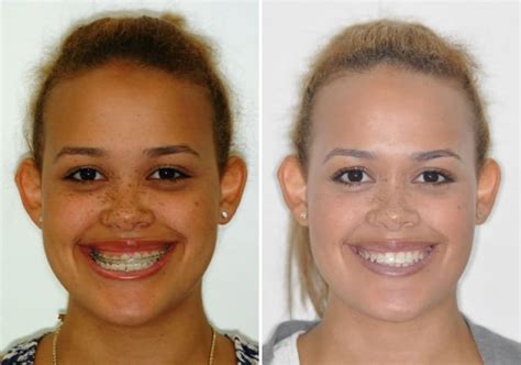 Case 4 Upper And Lower Jaw Surgery Sydney Oral And Facial Surgery