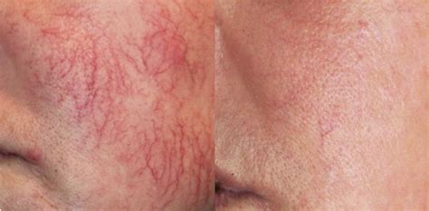 How To Get Rid Of Spider Veins On Your Face Connsense Bulletin