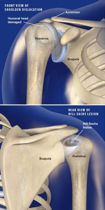 Hill Sachs Lesion Orthopedic Surgeon Prescott Valley Phoenix