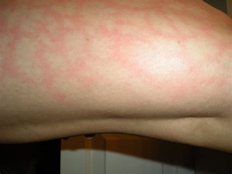 Skin Rashes On Arms Only Pictures Photos