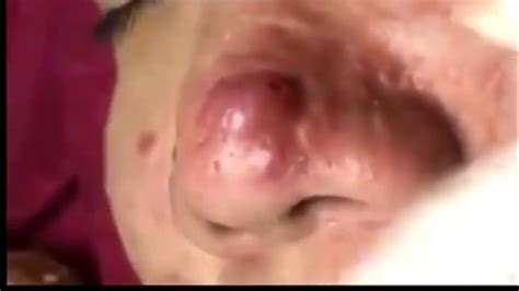 Big Infected Cystic Acne Removal On Nose Please Youtube
