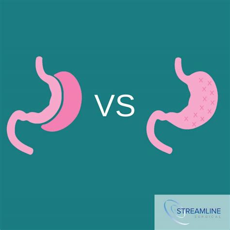 Endoscopic Gastric Sleeve Vs Traditional Gastric Sleeve Streamline