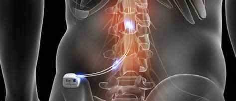 Spinal Cord Stimulator Specialist Fairfax County And Stafford Va And
