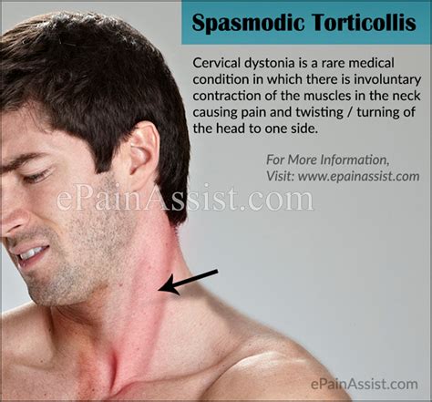 Spasmodic Torticolliscausessymptomstreatmenthome Remedies
